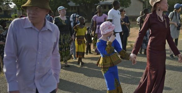 Tanzanie: des associations dénoncent la « recrudescence » des attaques contre les albinos