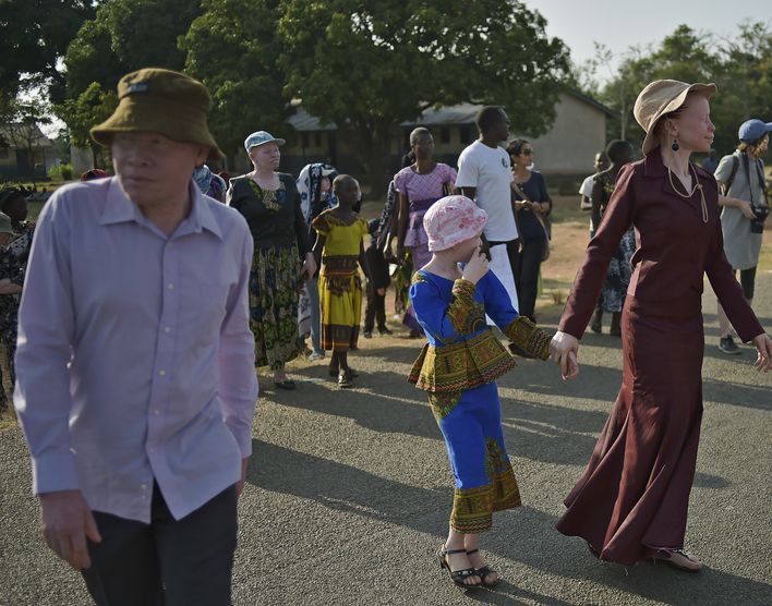 Tanzanie: des associations dénoncent la « recrudescence » des attaques contre les albinos