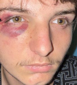 "Je suis encore sous le choc" : Paul, 17 ans, passé à tabac dans le Tarn parce qu’il est homosexuel