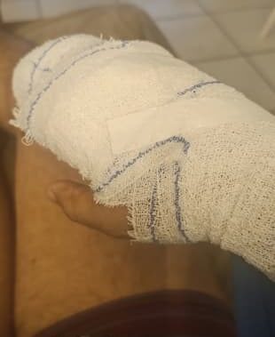 Main du policier blessé lors d'une intervention à Malakoff
